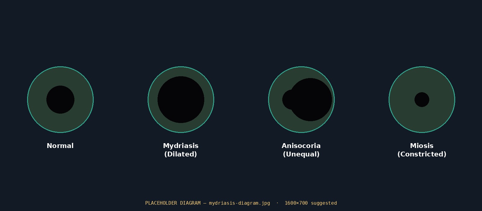 Diagram comparing normal pupil, mydriasis, anisocoria and miosis